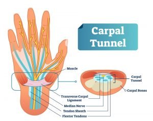 What is Carpal Tunnel Syndrome